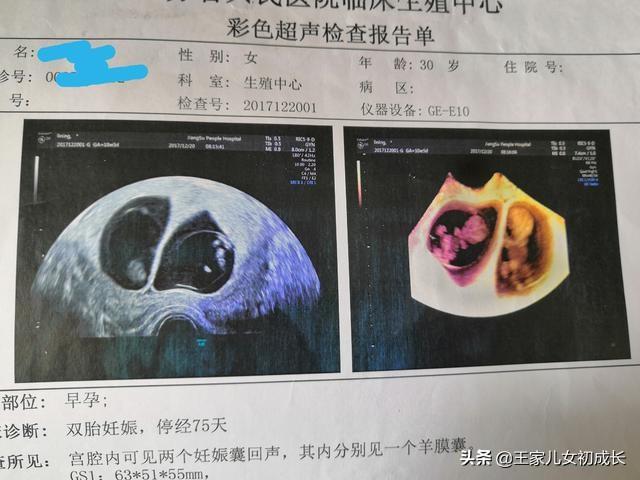 你的育儿经|我的试管之路7—喜极而泣盼来久违的双杠，一超迎来我的双胎宝贝