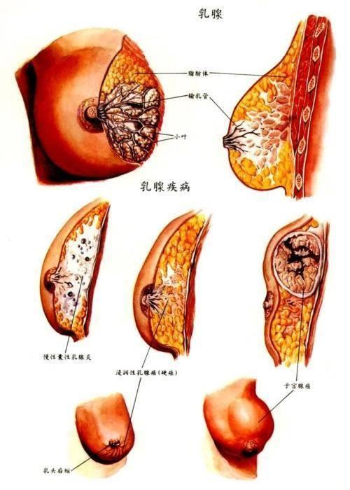 乳腺癌取代肺癌成全球第一大癌，济南乳腺病医院院长直播详解乳腺