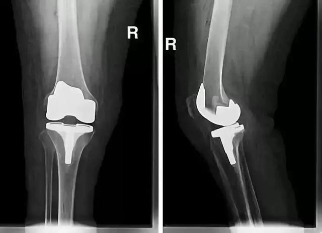 生理年龄|为何大多数老年人都会膝关节疼痛？如何破解？