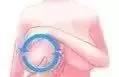 “乳腺增生”怕刮痧，多刮刮就好了