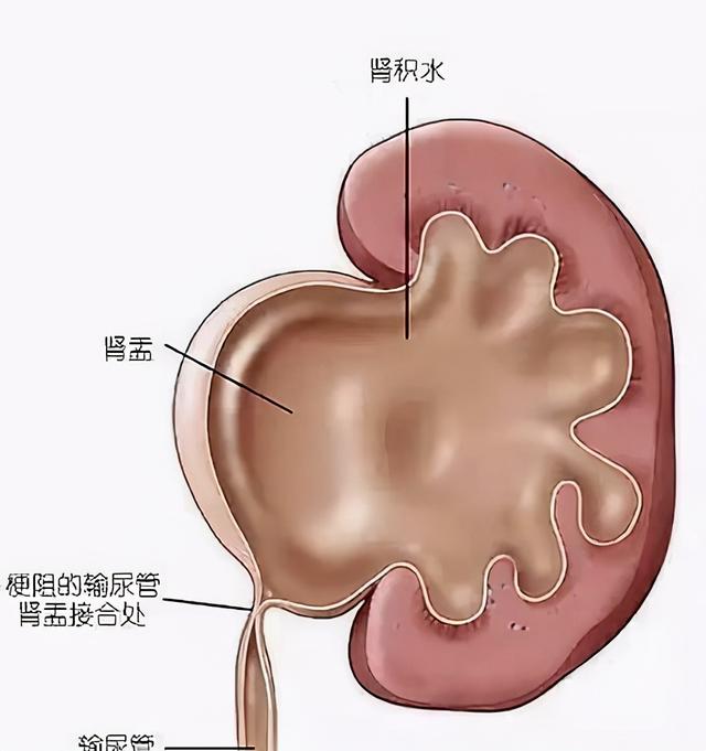 很多人在体检的时候发现自己的肾结石小于两公分，觉得没什么大事