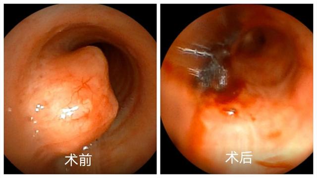 患者|想要自由呼吸？这个团队来帮您