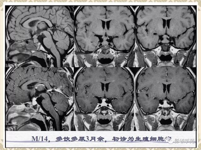 垂体病变的MRI诊断