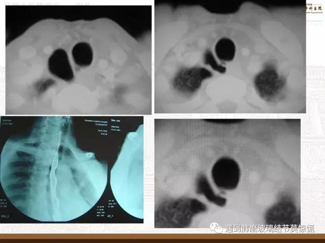 遇到气管、支气管憩室莫惊慌