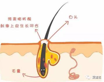 捣蛋鬼|悄悄告诉你，有一种痘痘是晒出来的