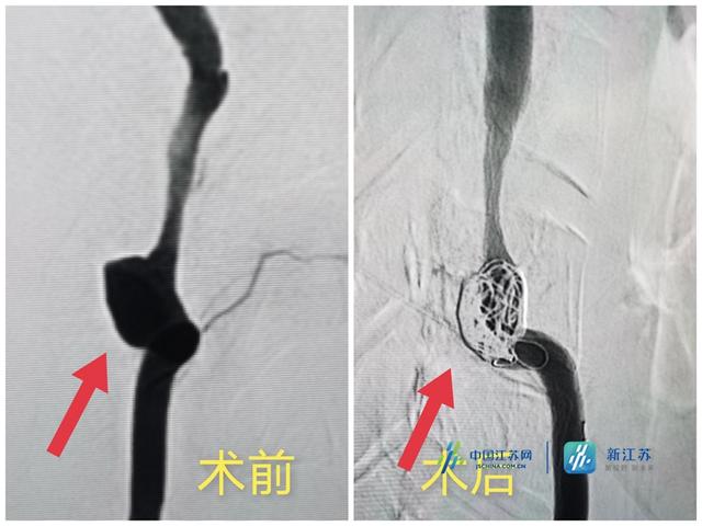 动脉瘤|小伙头颈痛被确诊椎动脉夹层动脉瘤 专家巧施支架辅助弹簧圈栓塞解难题