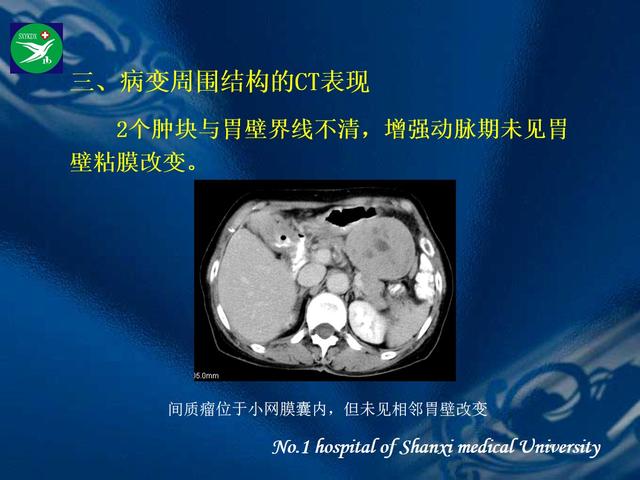 李健丁教授：胃肠道外间质瘤的CT表现和临床病理分析