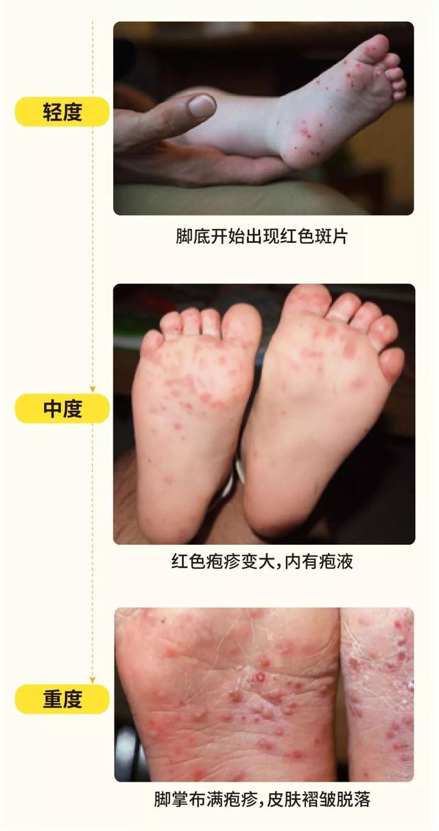 生活矜持点|家长们注意了！现在仍是手足口病高发期，应如何预防？