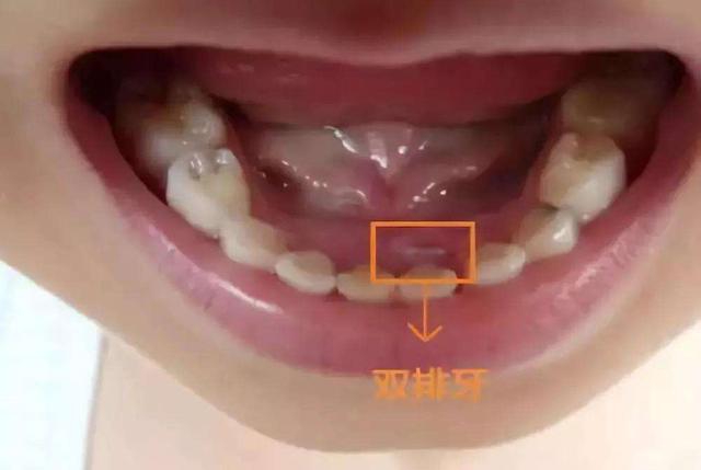 为啥现在很多宝宝都长“双排牙”？医生：都是妈妈喂出来的