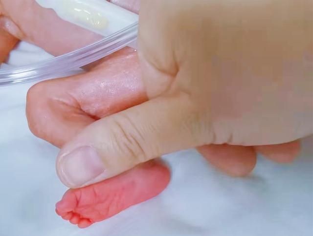 宝宝|出生体重仅550克！“手掌姑娘”的惊心脱险记