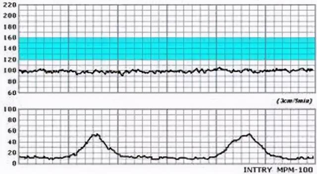 宝妈健康小贴士：怎样做胎心监护更容易过关？准妈妈快收藏