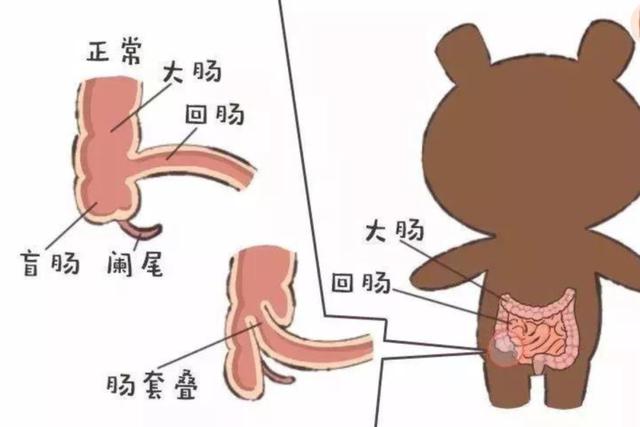 [夕阳下的彩虹]截掉20厘米肠子，娃才保住命！3岁内高发请注意！