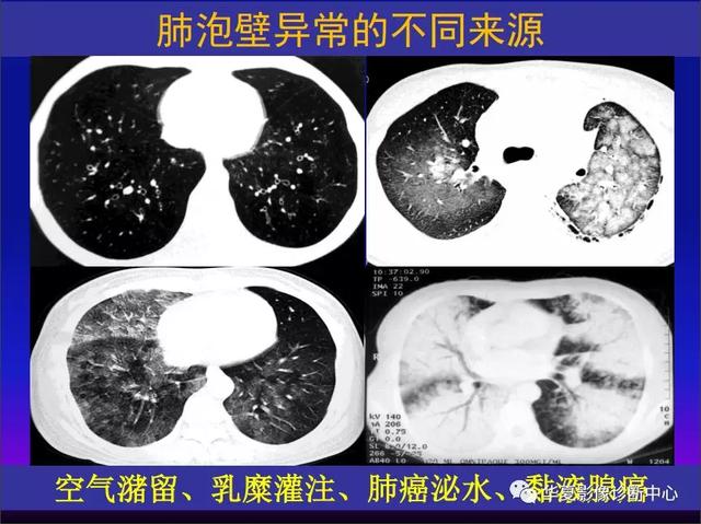 肺间质性疾病的解剖、病理、影像分析