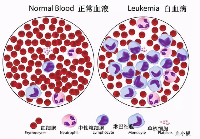 儿童白血病死亡率高居榜首！医生提示：远离白血病要避开五种因素