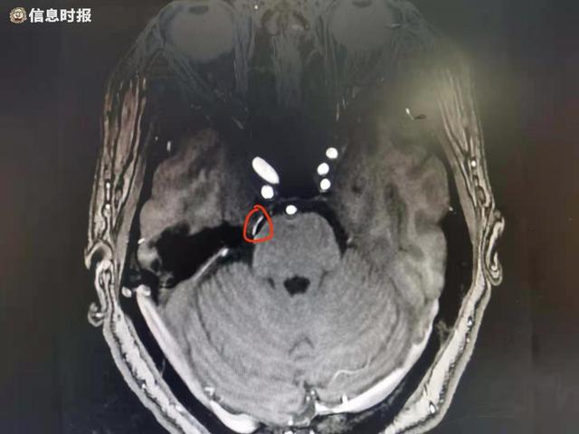 大乌龙！女子“牙痛”难忍，拔了3颗大牙后发现罪魁祸首是这“天下第一痛”...