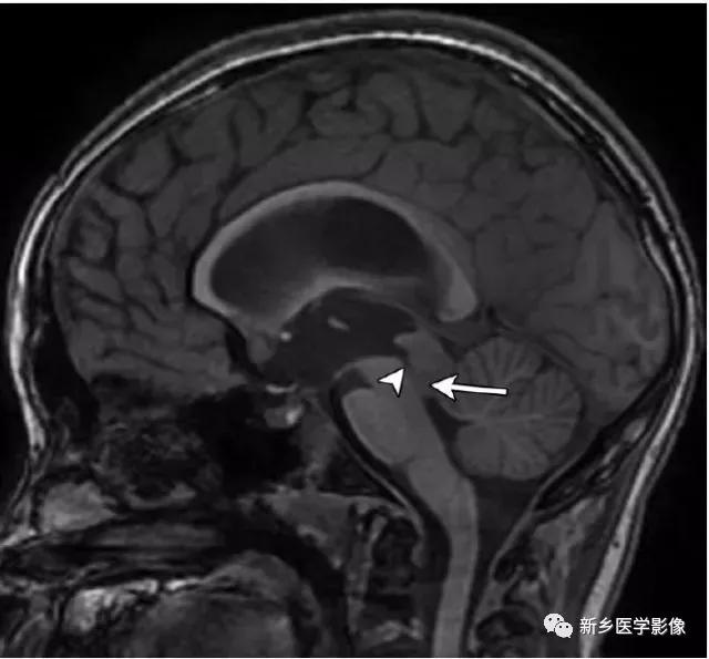 大脑中线处常见的25种疾病