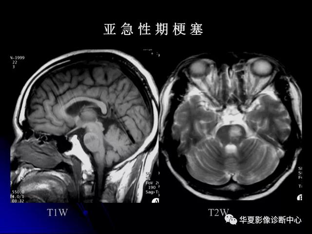 「影像复习」脑干区常见病变影像表现