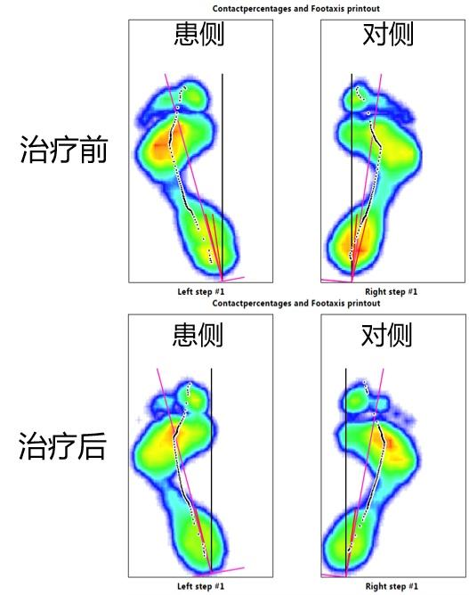 患者|得了帕金森病后，足部痉挛怎么办？