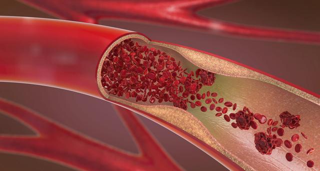 血管“堵塞”毫无征兆？晨起有4种不适，或是血栓来访！切莫大意