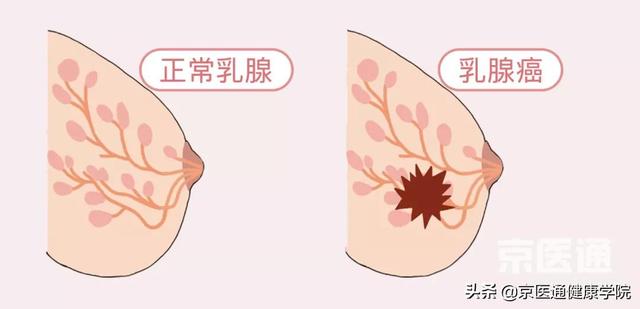 乳腺增生、结节、癌，摸起来什么感觉？医生教你分辨