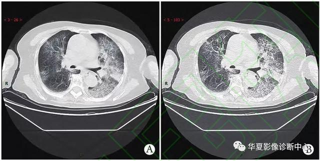 「影像进展」新冠肺炎的CT典型和不典型表现以及影像学分期