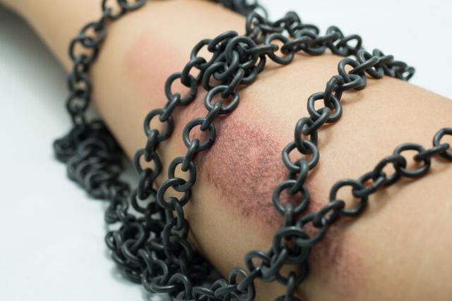 老人的幼年伤疤竟长成癌症！医生警告：3种疤更易“癌变”