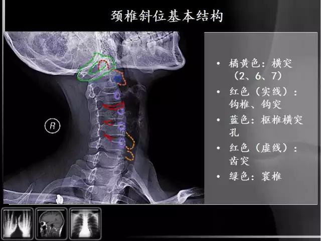 通俗易懂的脊椎X光片读片指南，值得收藏