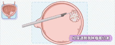 肿瘤|膀胱癌怎么治疗？