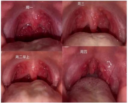 「你的育儿经」当心！疱疹性咽峡炎起病急、易高烧、传染快一旦感染，孩子太遭罪