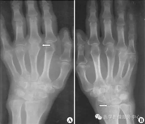 77种骨肌影像病例，助你诊断无忧