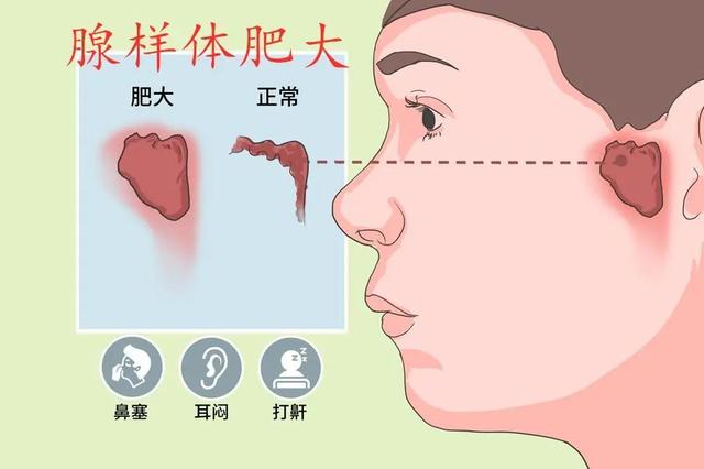 孩子|家有“呼噜娃”，居然要手术？