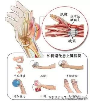 拇指伸不直，掰直了弯不回来还痛，因为啥？