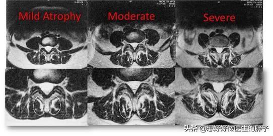 腰间盘|腰间盘突出症患者必须绝对卧床才能好吗？医生：适度活动会更好