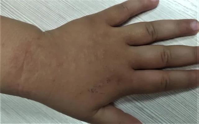 你的育儿经|夏日常见儿童皮肤病—沙土皮炎