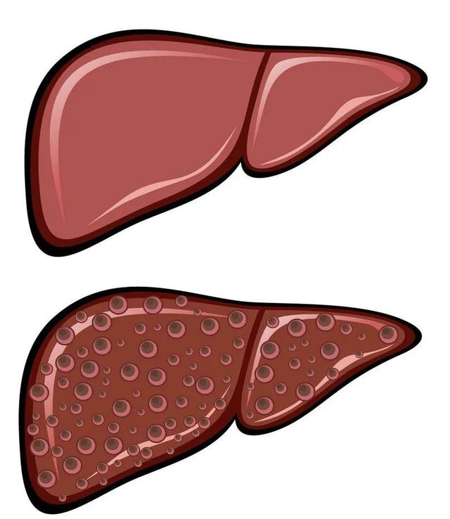 肝硬化|肝硬化并发症知多少