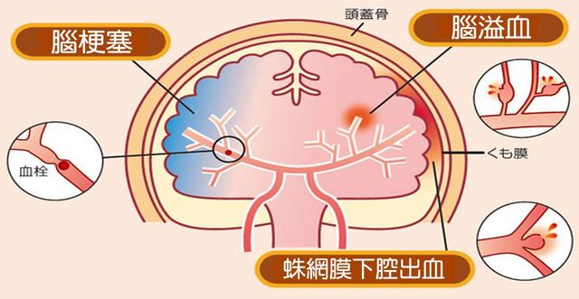 医生提醒：脑梗发作前，身体会发出4个&quot;求救信号&quot;，别自己扛着