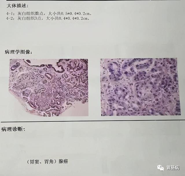 男子左上腹疼，以为是“带状疱疹”，幕后真凶却出人意料