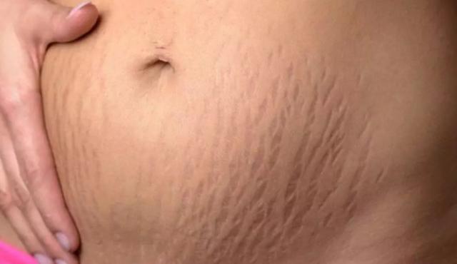 你的育儿经■产后有妊娠纹怎么办？教你这三招，轻松修复肚皮！