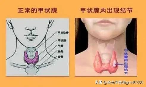 从中医角度谈甲状腺结节的产生。如何预防结节恶化？