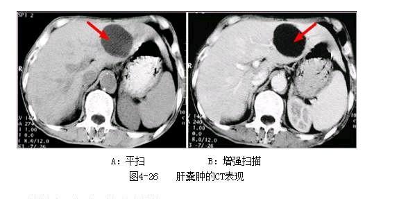 体检报告自己看——肝囊肿