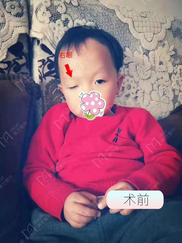 「你的育儿经」刚出生的宝宝发现一个眼大一个眼小咋回事？