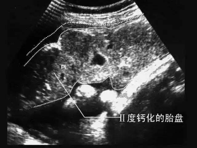 超级宝妈@补钙会使胎盘钙化？医生：两者没有任何关系