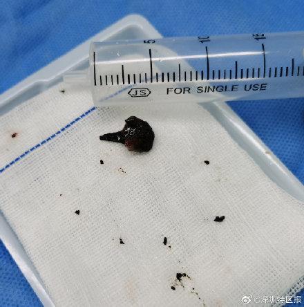 咳嗽|鱼骨头卡在肺里12年后被取出