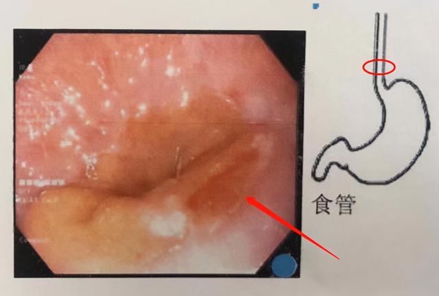 经常反酸，感觉喉咙被堵？这些人群尤其要警惕反流性食管炎