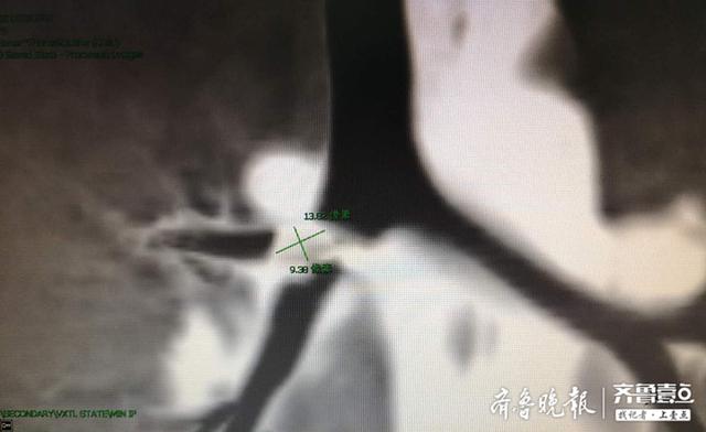 「超级宝妈」好险！1岁宝宝珠子卡喉，危急时刻济医附院耳鼻喉科成功救治