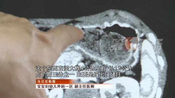 孩子|女童腹痛，竟是吃的东西“不寻常”……它们占了胃部三分之一