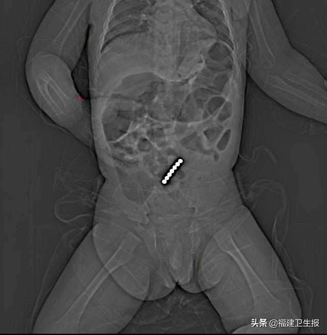 磁力|误吞7颗磁力珠，福建1岁幼童肠穿孔！医生提醒：家长选择玩具要慎重