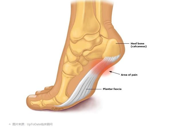 有种脚痛叫「足底筋膜炎」！不花冤枉钱，医生教您真正有用的方法