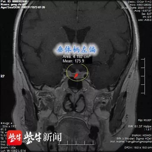 脑内长了肿瘤，神奇！医生将垂体瘤从鼻子里“夹”了出来