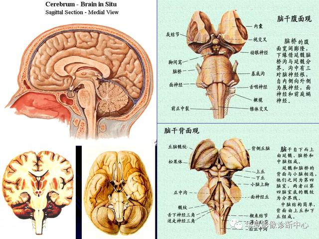 「影像复习」脑干区常见病变影像表现